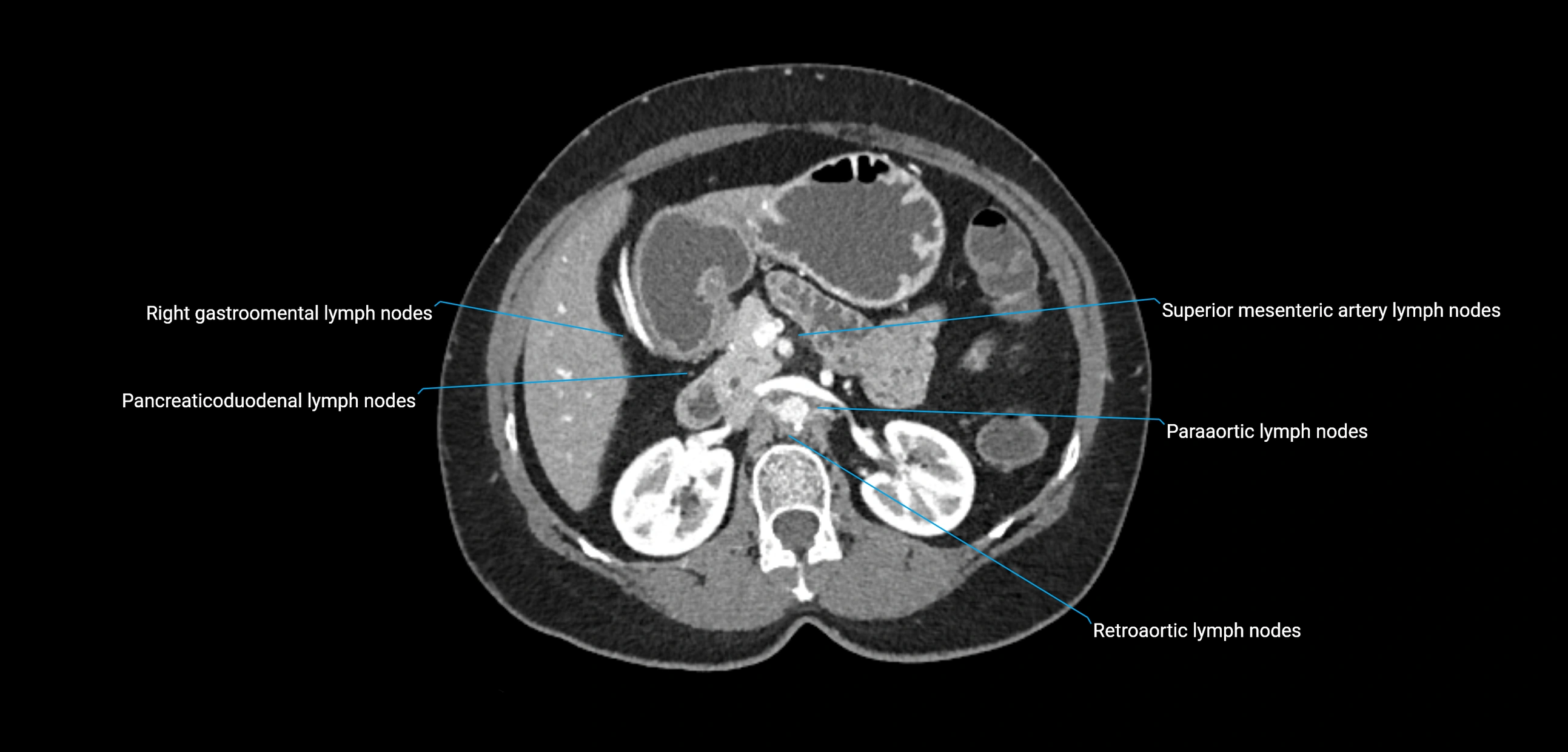 CT ct abdominal lymph nodes  axial cross sectional anatomy  enchanced radiology image -img-00002-00168.webp